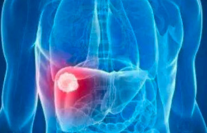 肝癌是中國第二大腫瘤致死病因！你是高危人群嗎？